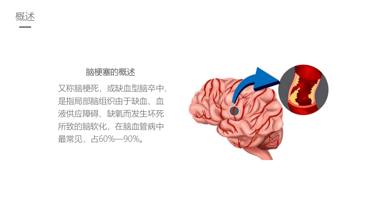 脑梗塞的护理业务学习课件4