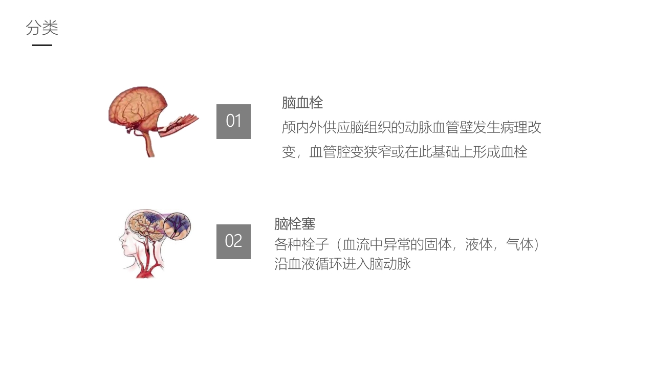 脑梗塞的护理业务学习课件6