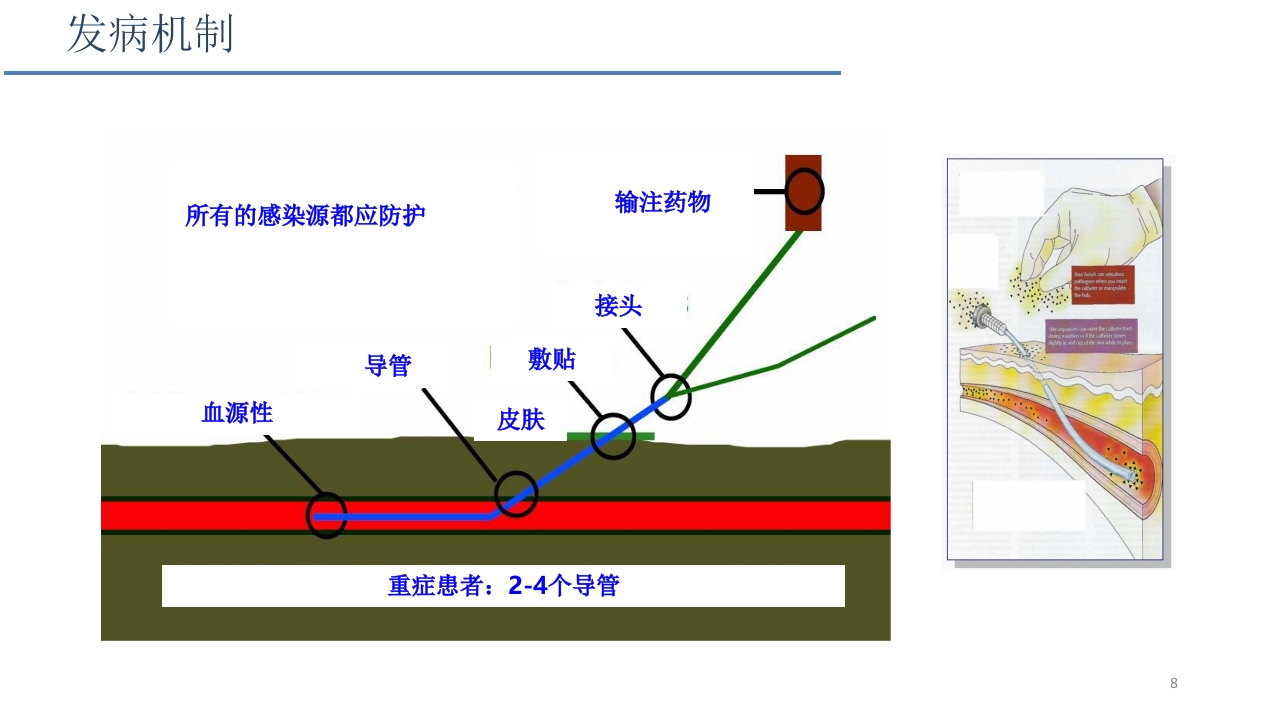 侵入性操作相关感染防控PPT课件8