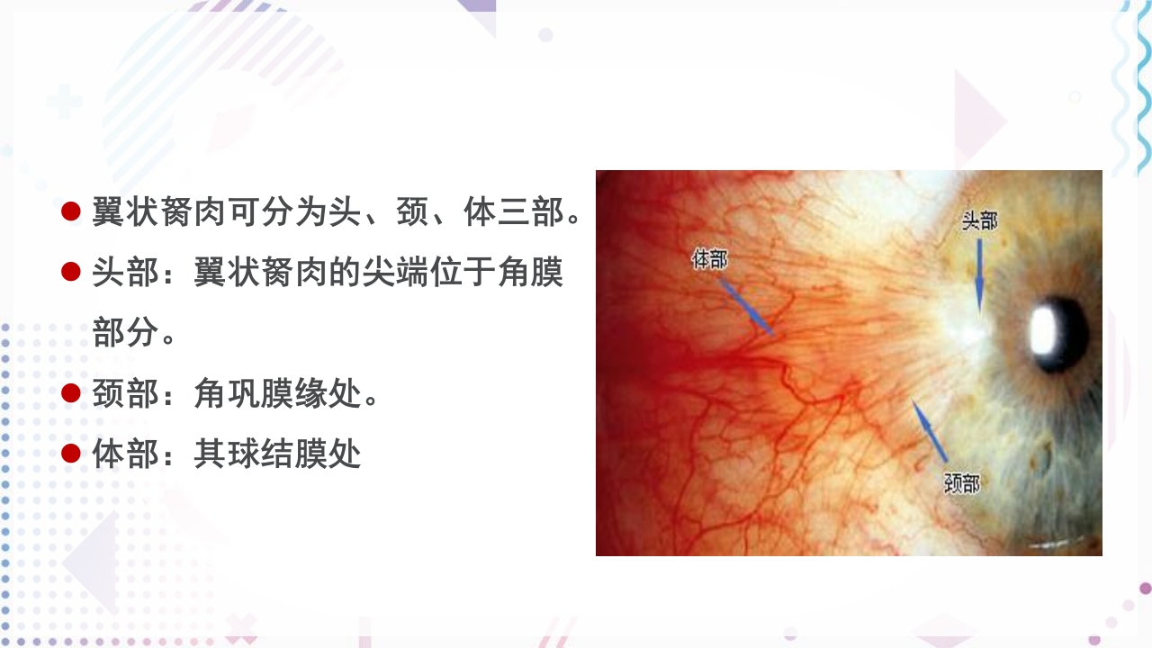 翼状胬肉的护理查房ppt5