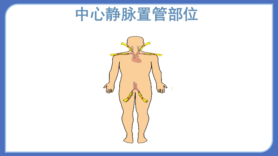 血液透析的血管通路PPT课件10