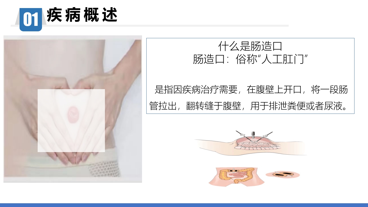 一例回肠造口周围皮肤粪水性皮炎患者的个案护理PPT课件4