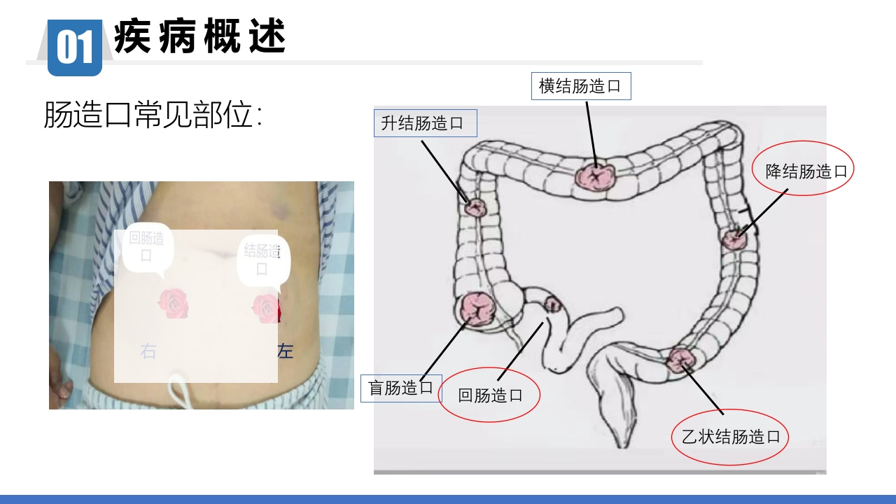 一例回肠造口周围皮肤粪水性皮炎患者的个案护理PPT课件6