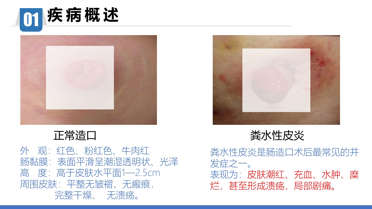 一例回肠造口周围皮肤粪水性皮炎患者的个案护理PPT课件9