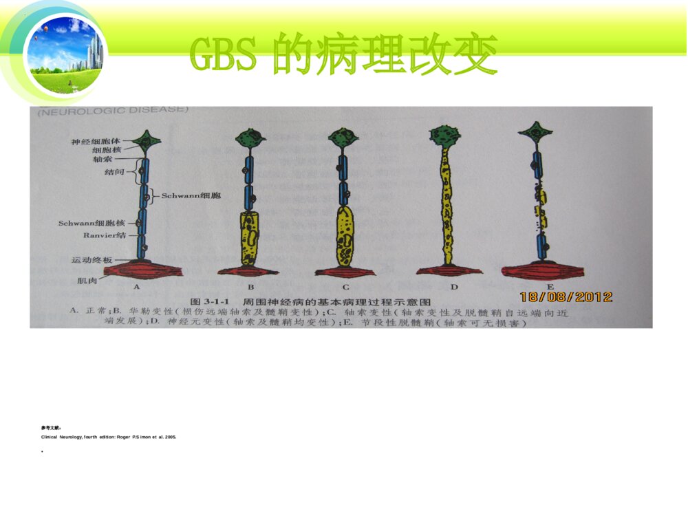 格林巴利综合征的护理ppt课件下载9