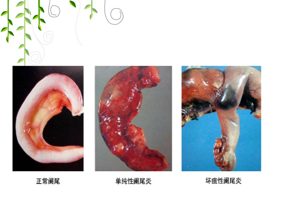 腹腔镜阑尾手术护理查房ppt课件9