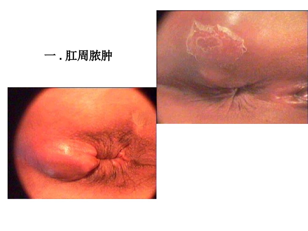 肛周脓肿与肛瘘ppt课件下载3