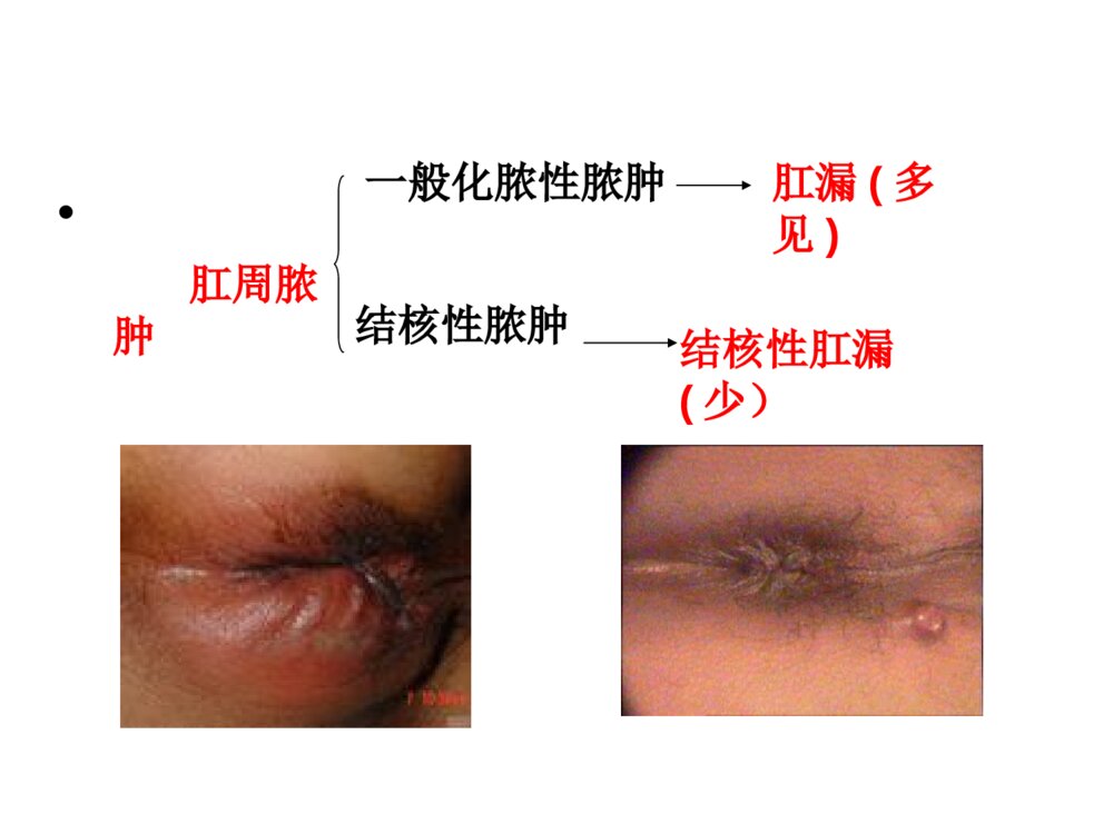 肛周脓肿与肛瘘ppt课件下载4
