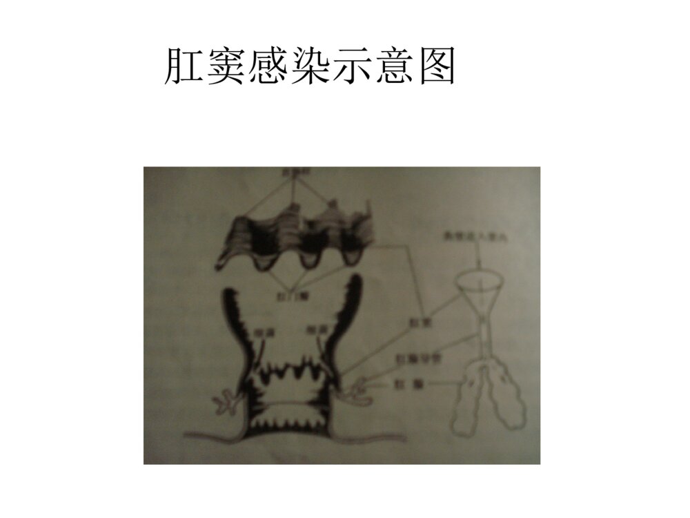 肛周脓肿与肛瘘ppt课件下载6