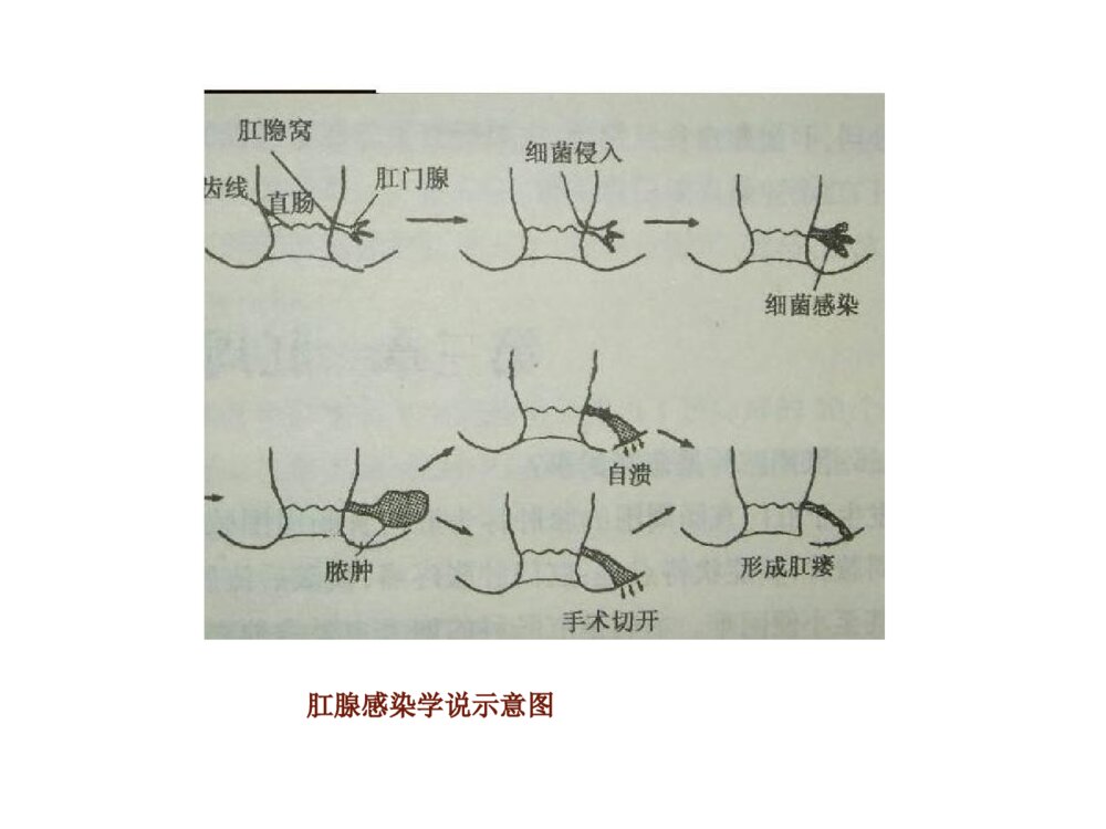 肛周脓肿与肛瘘ppt课件下载7