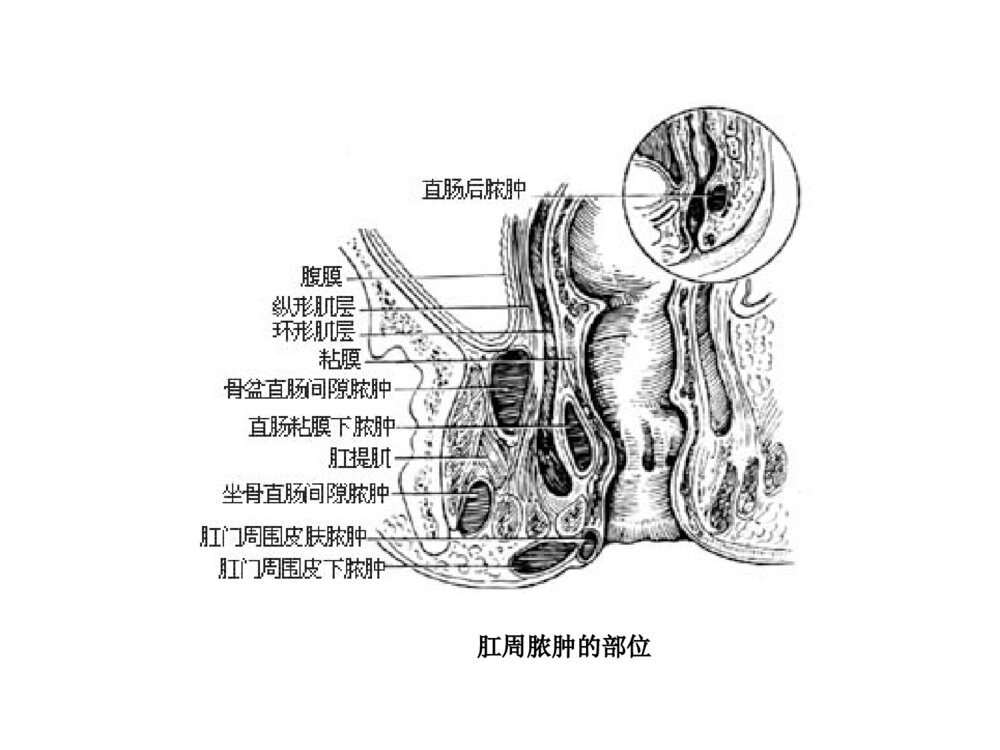 肛周脓肿与肛瘘ppt课件下载9