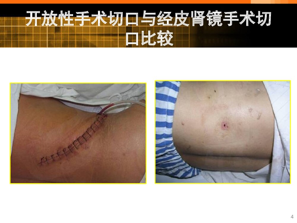 经皮肾境碎石取石术的护理查房PPT课件（带内容）4