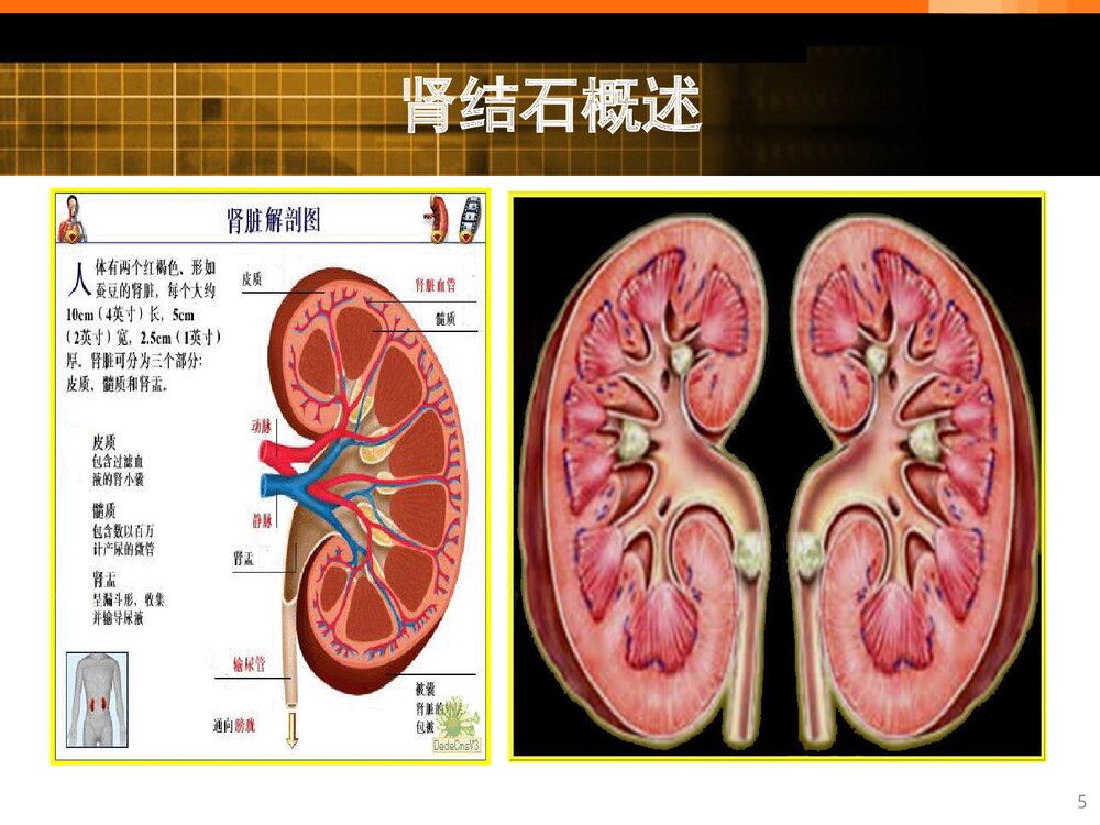 经皮肾境碎石取石术的护理查房PPT课件（带内容）5