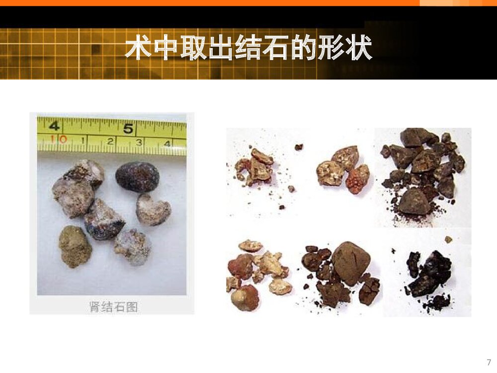 经皮肾境碎石取石术的护理查房PPT课件（带内容）7