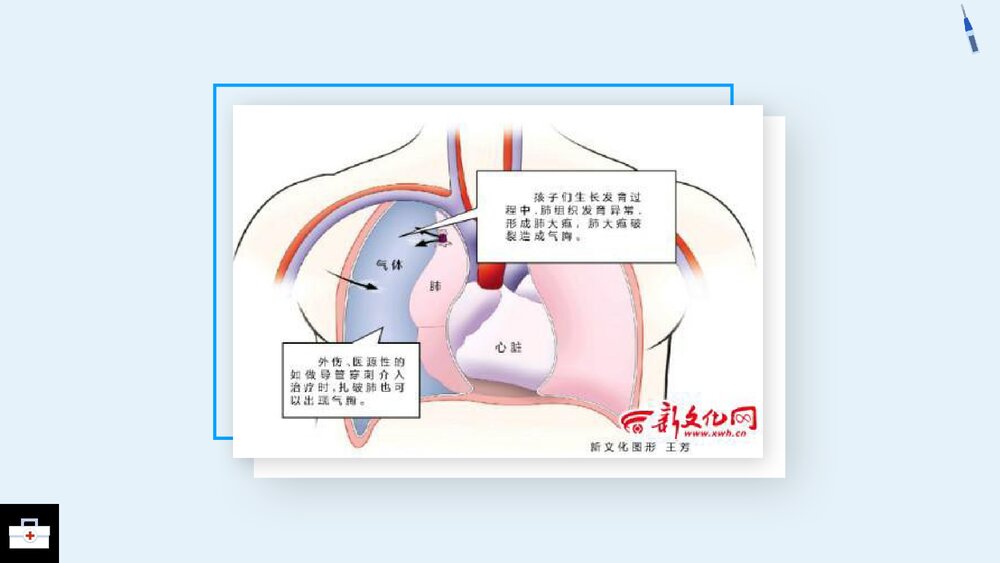 气胸病人的护理查房PPT课件6