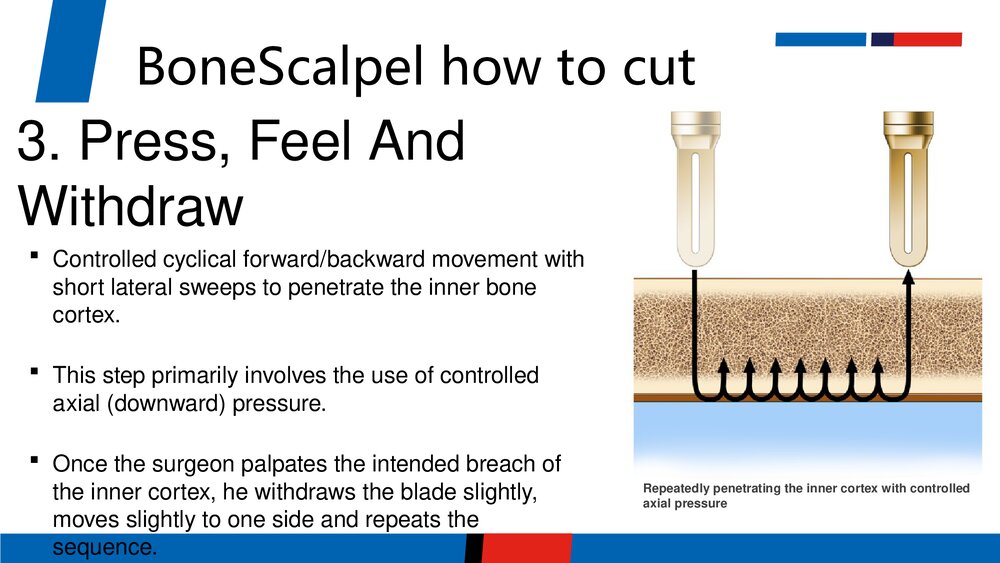 超声骨刀PPT课件(英文版)7