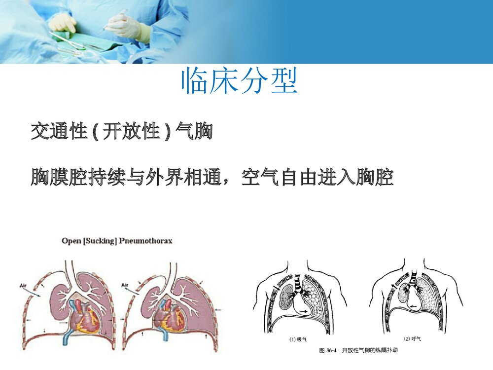 自发性气胸护理教学查房PPT课件下载6