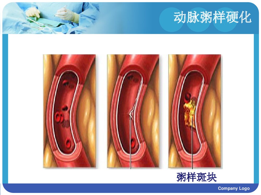 冠心病护理查房PPT课件3