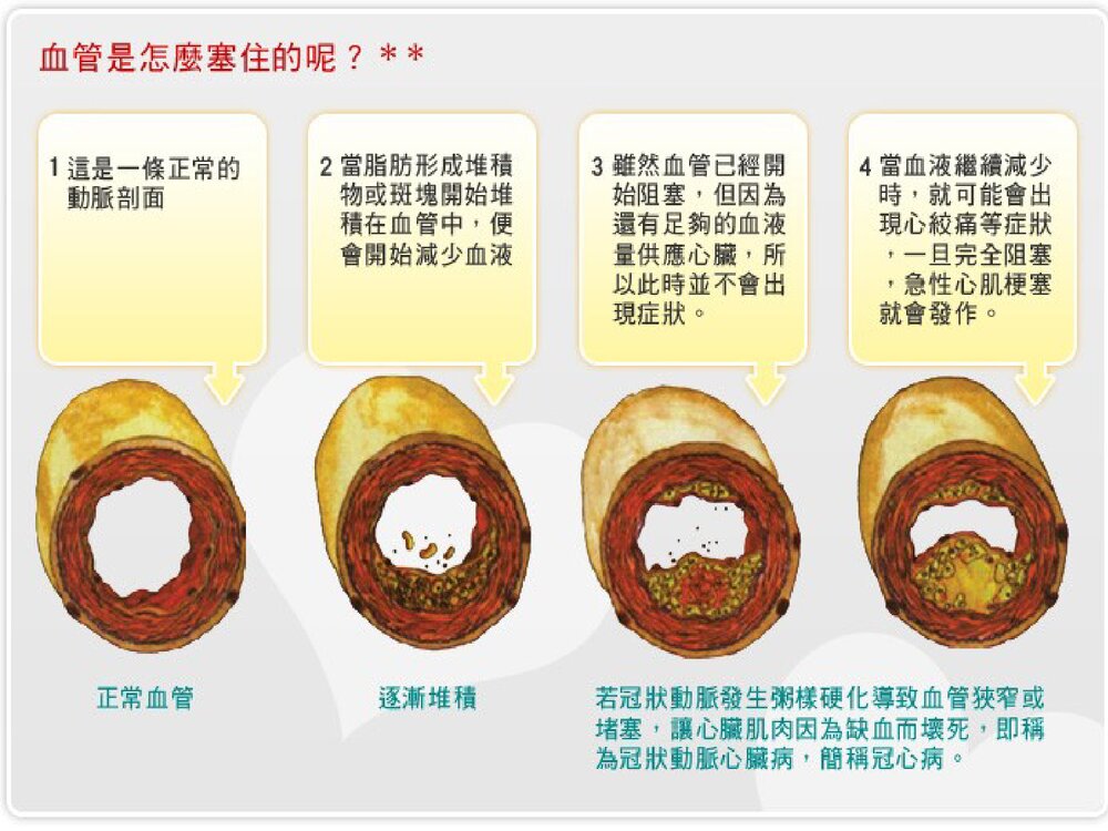 冠心病护理查房PPT课件4