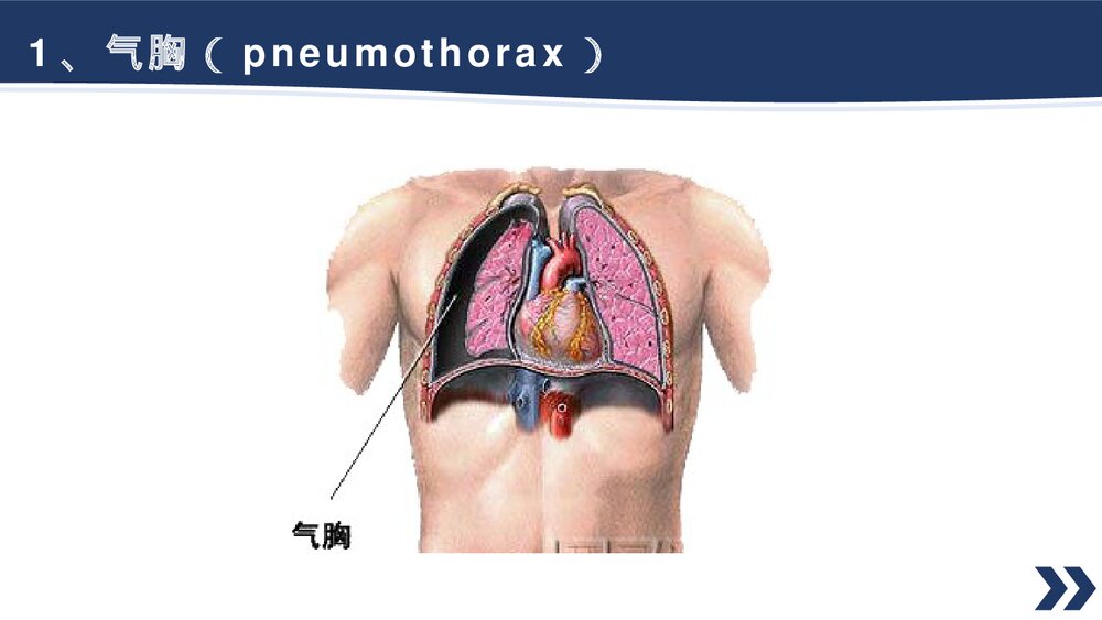 气胸的诊断治疗PPT课件3
