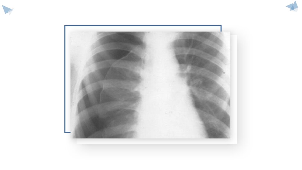 气胸的护理查房PPT课件(带内容)3