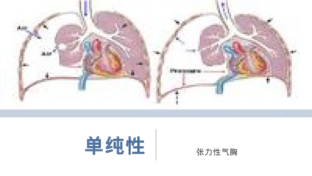 气胸的护理查房PPT课件(带内容)5