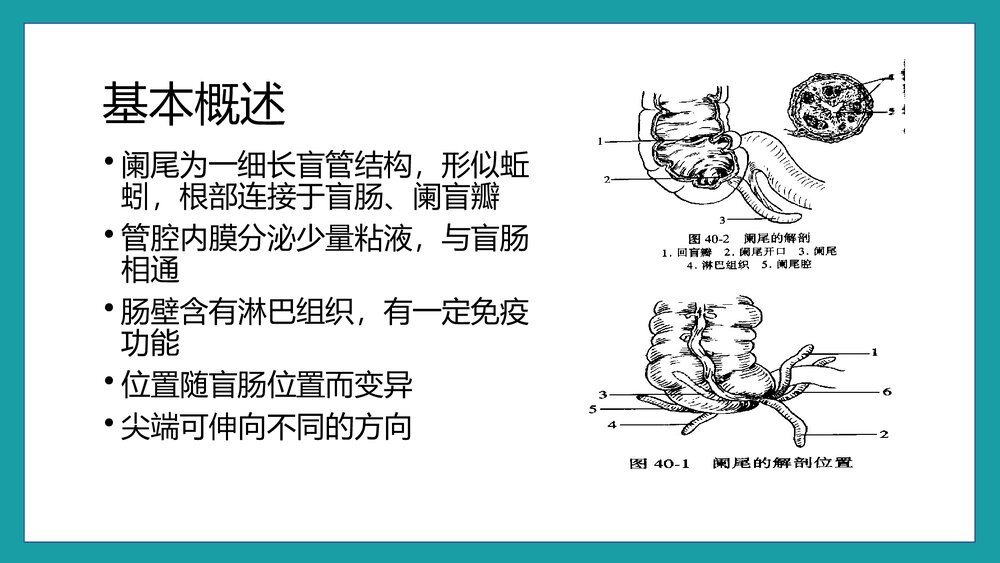 急性阑尾炎的护理查房PPT课件5