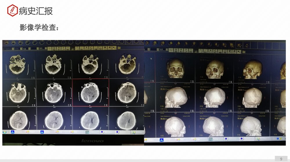 一例重度颅脑损伤护理查房PPT课件下载9