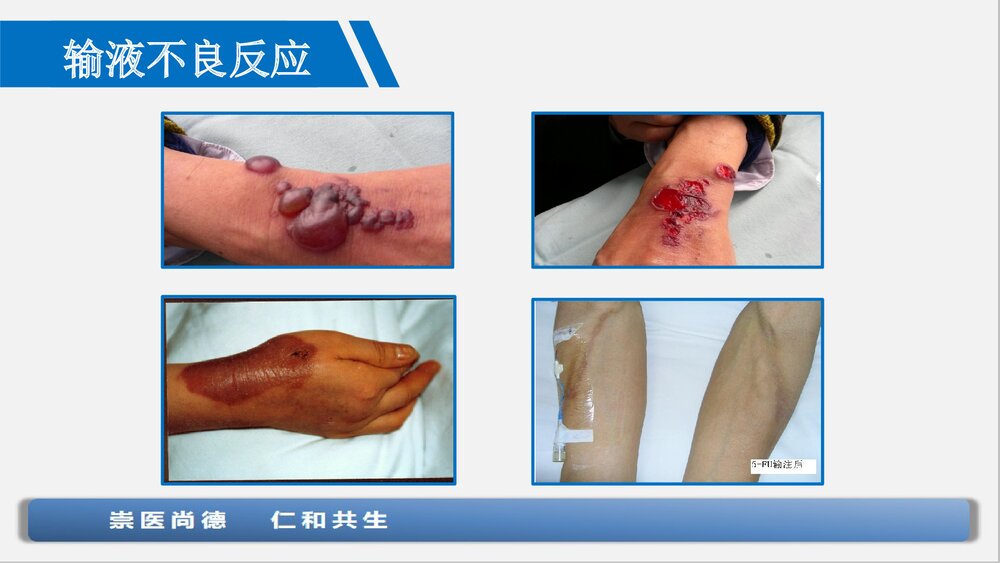 血管保护与输液工具合理选择PPT课件下载3