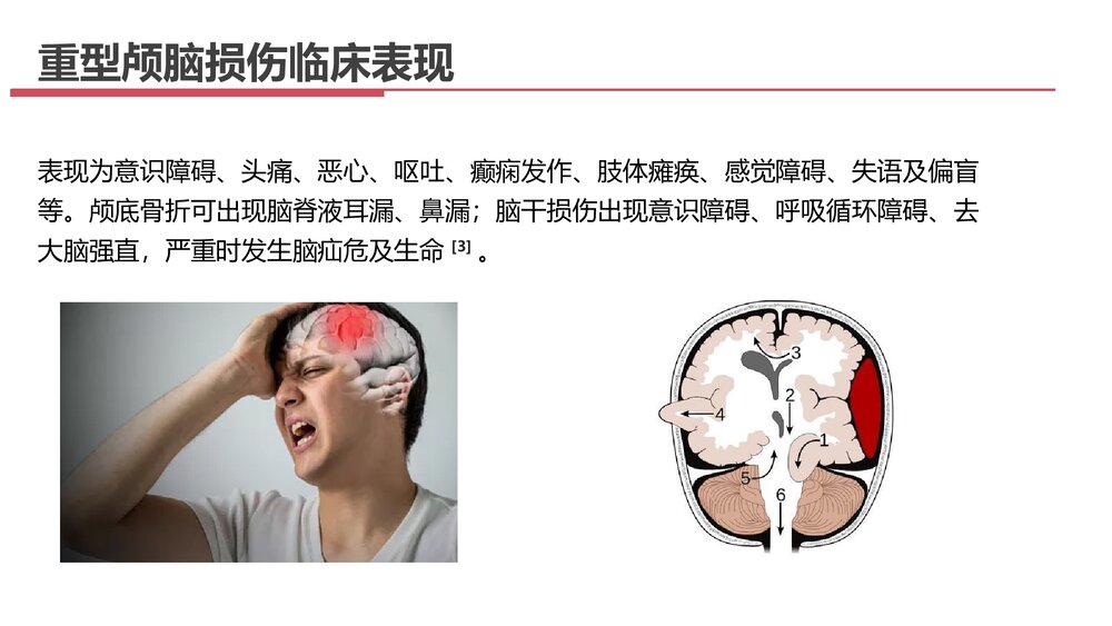 重型颅脑损伤患者护理查房PPT课件下载6