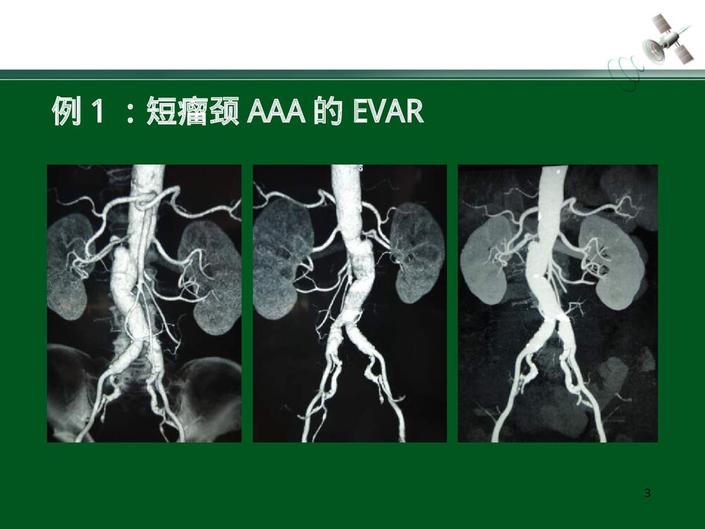 复杂腹主动脉瘤的腔内治疗PPT下载3