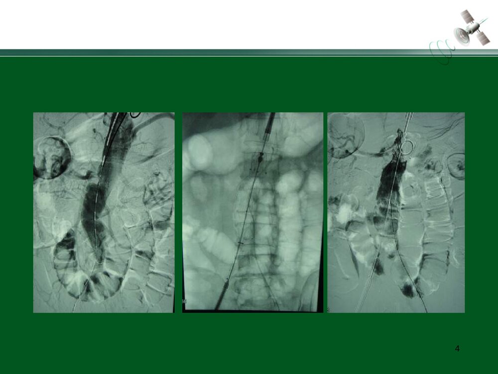 复杂腹主动脉瘤的腔内治疗PPT下载4