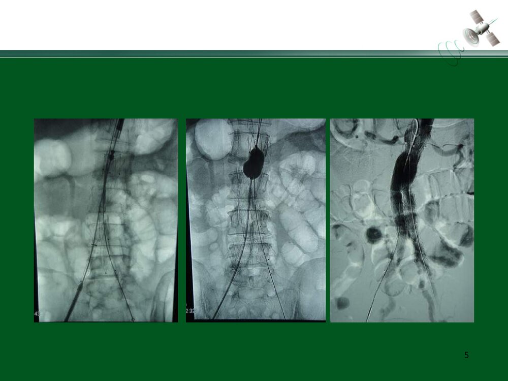 复杂腹主动脉瘤的腔内治疗PPT下载5