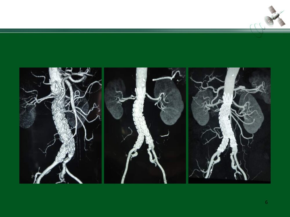复杂腹主动脉瘤的腔内治疗PPT下载6