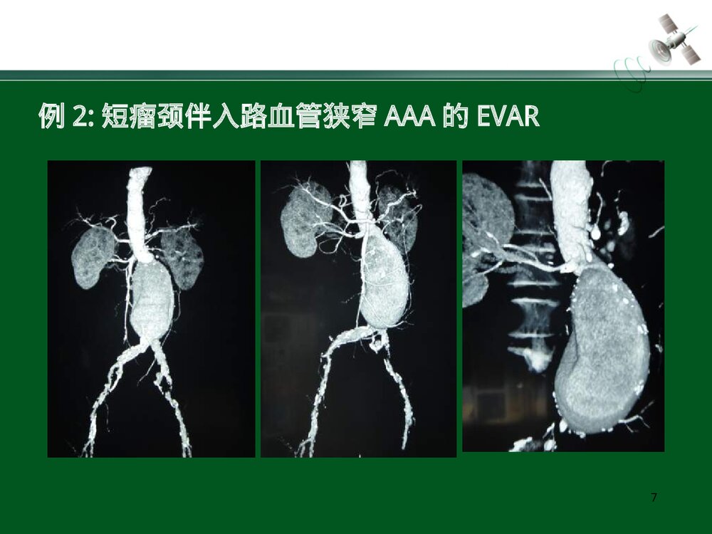 复杂腹主动脉瘤的腔内治疗PPT下载7