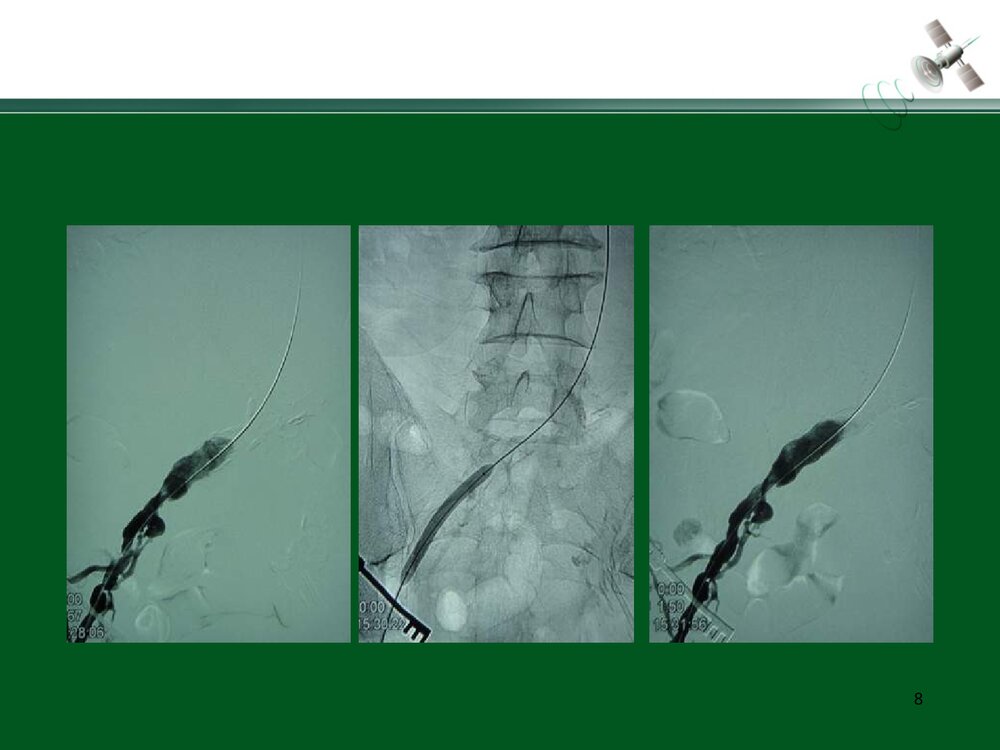 复杂腹主动脉瘤的腔内治疗PPT下载8