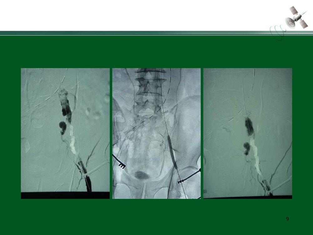 复杂腹主动脉瘤的腔内治疗PPT下载9