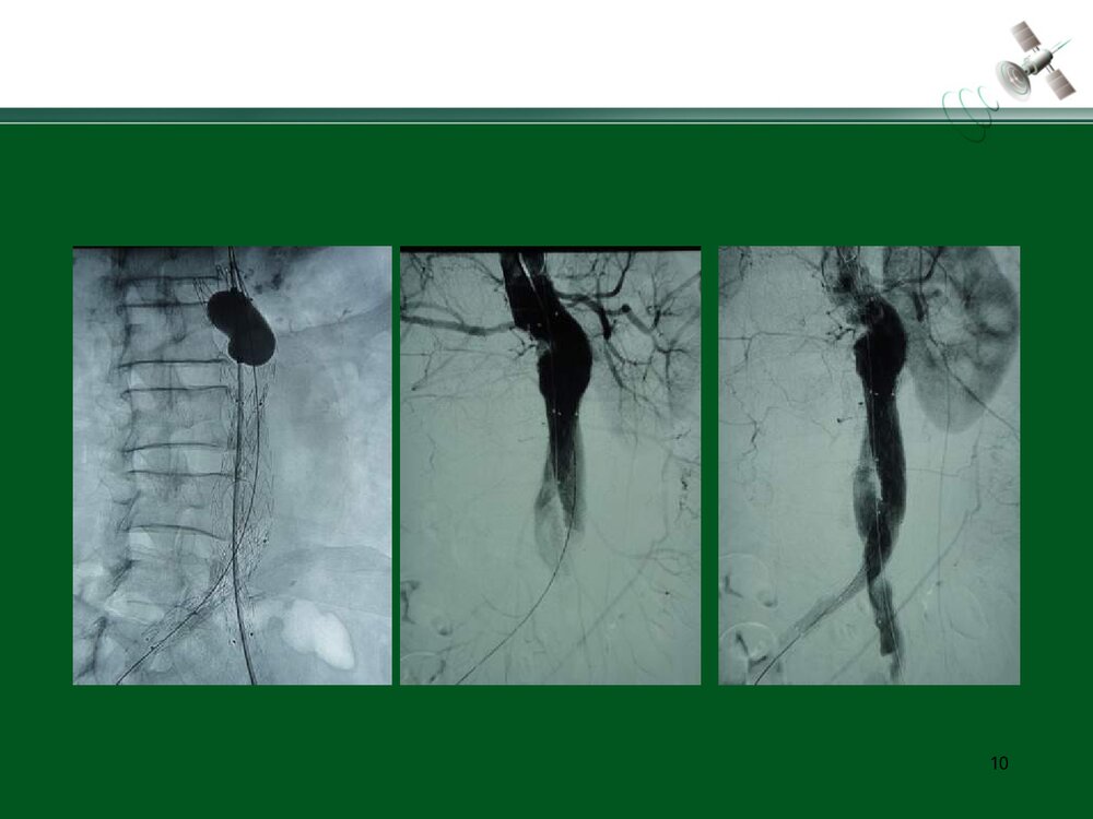 复杂腹主动脉瘤的腔内治疗PPT下载10