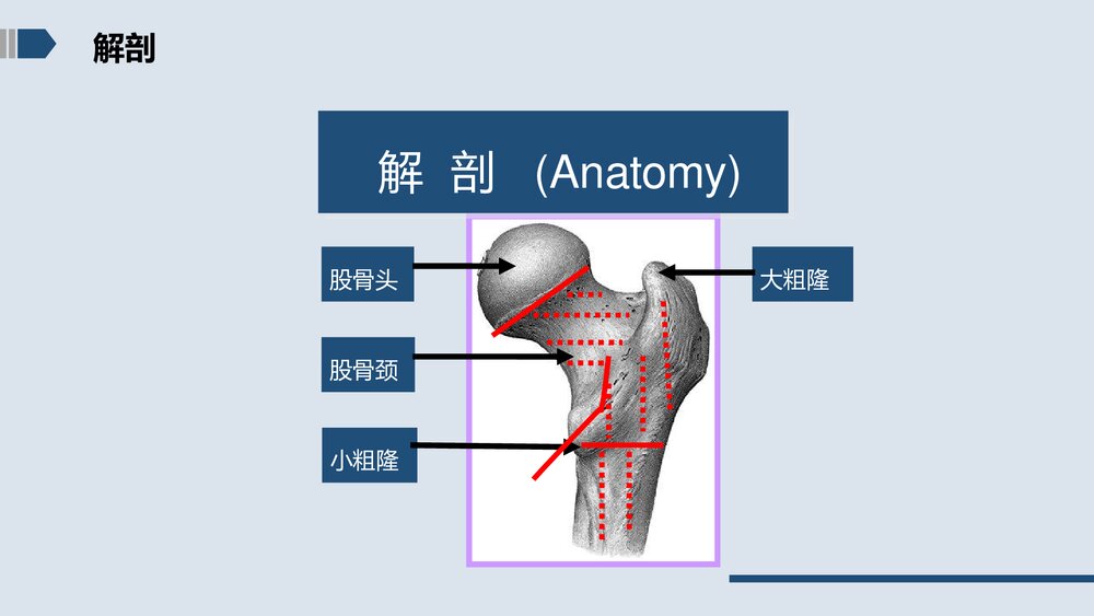 股骨颈骨折的护理PPT课件下载7
