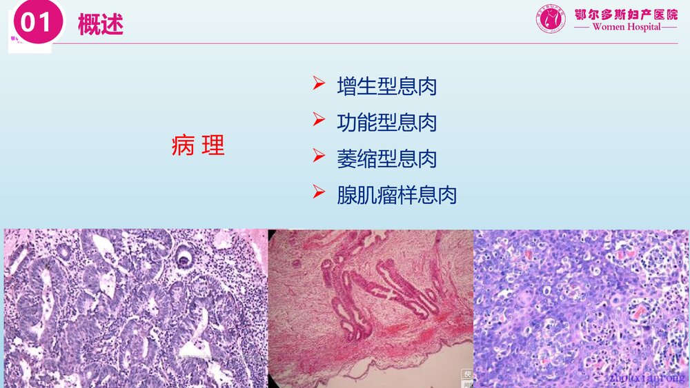 子宫内膜息肉的诊断治疗和复发预防PPT课件7