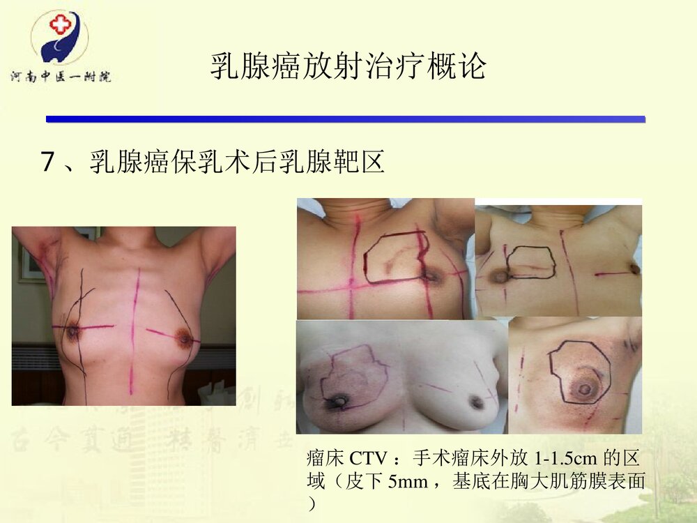 放疗在乳腺癌根治术后的运用及护理PPT课件下载10