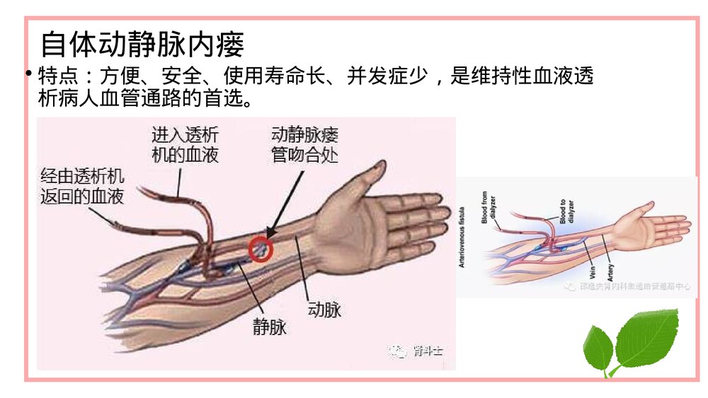 穿刺前对动静内瘘的评估PPT课件下载(共20页·带内容)7