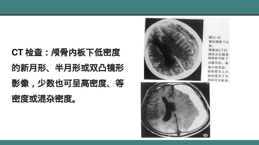 颅脑损伤的手术配合PPT课件下载(共28页·带内容)7