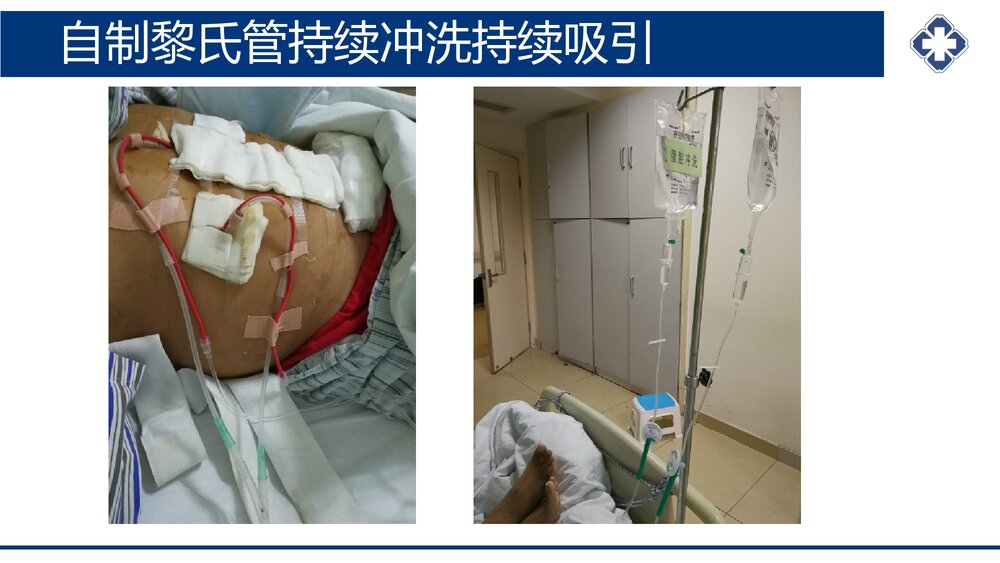 腹腔引流管冲洗护理PPT课件(共20页·可编辑修改)10