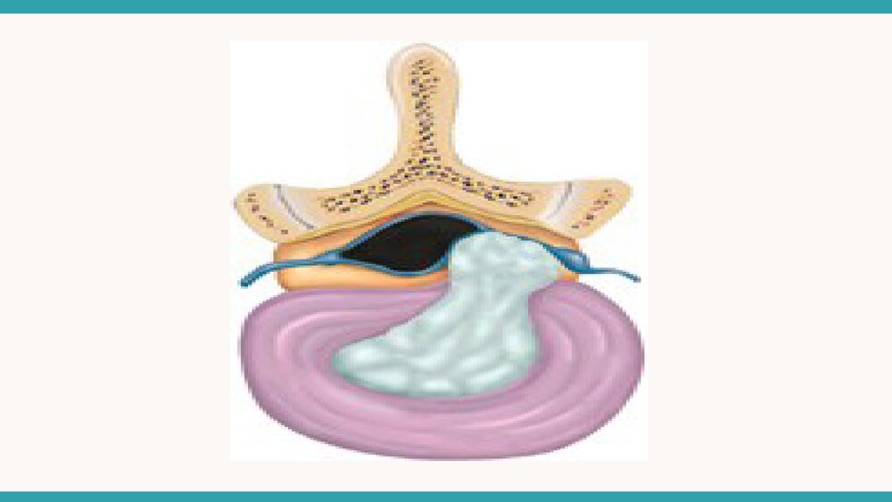 腰椎间盘突出症微创治疗与护理措施PPT课件下载2