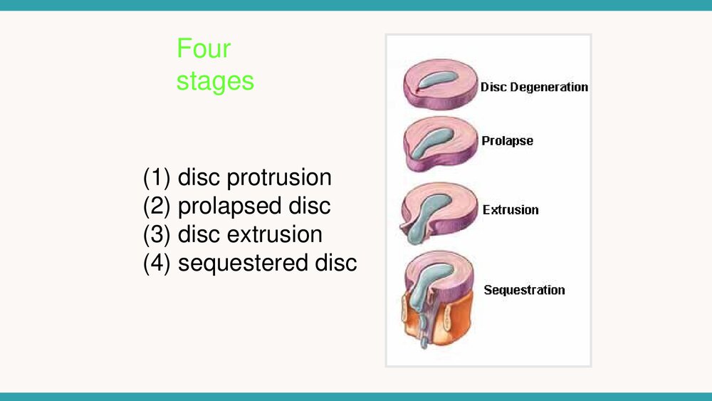 腰椎间盘突出症微创治疗与护理措施PPT课件下载7