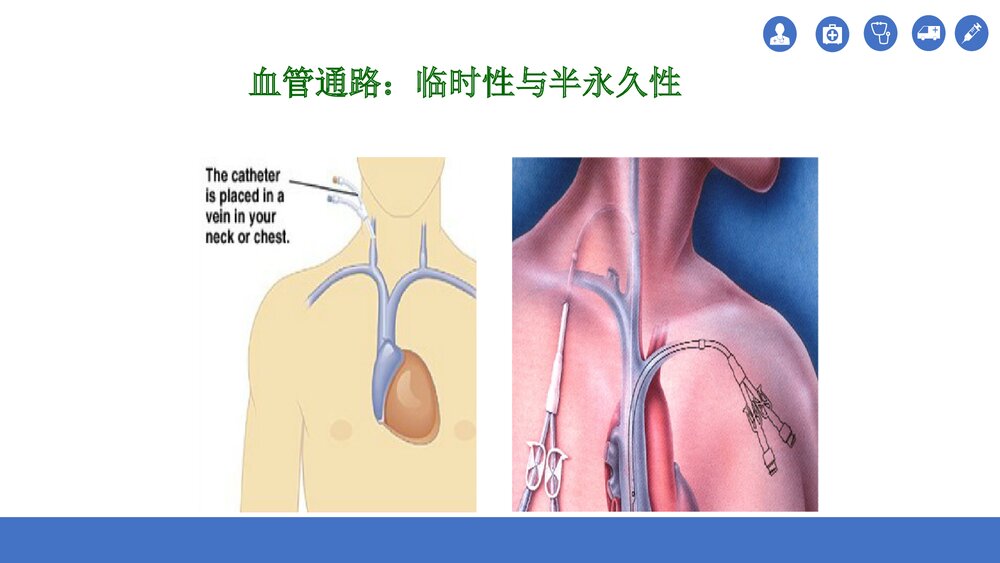 血透患者动静脉内瘘的护理PPT课件(共35页)5