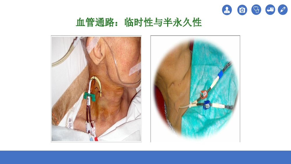 血透患者动静脉内瘘的护理PPT课件(共35页)6