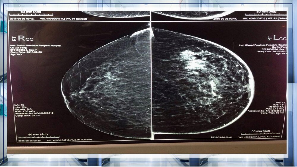 乳腺癌病例讨论PPT课件下载(带内容·共13页)8