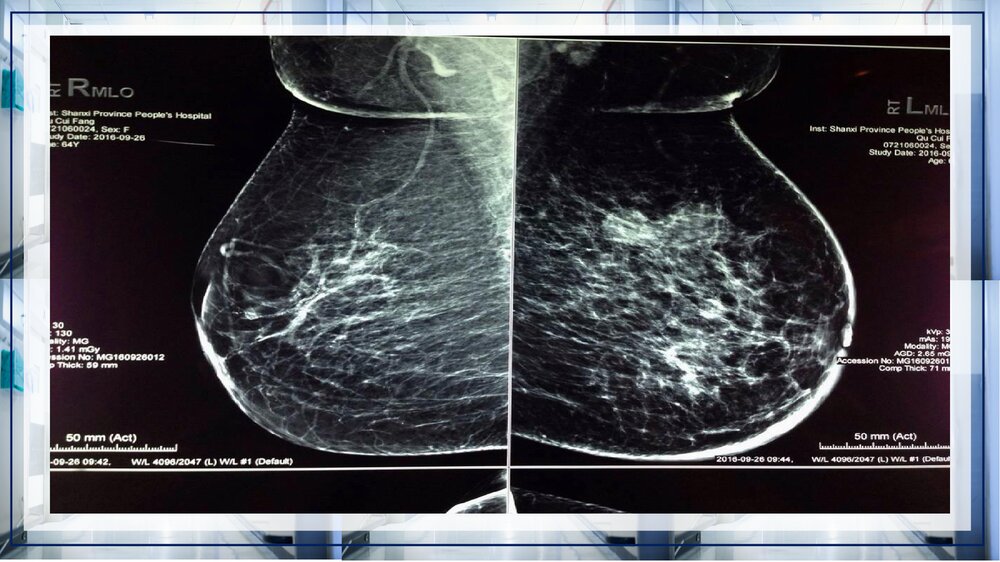 乳腺癌病例讨论PPT课件下载(带内容·共13页)9